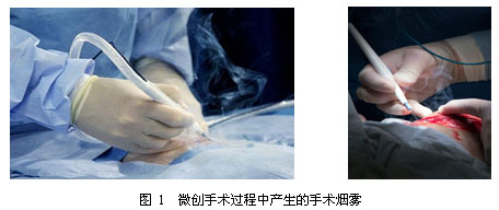 微创手术过程中手术烟雾的仿真与机理研究进展